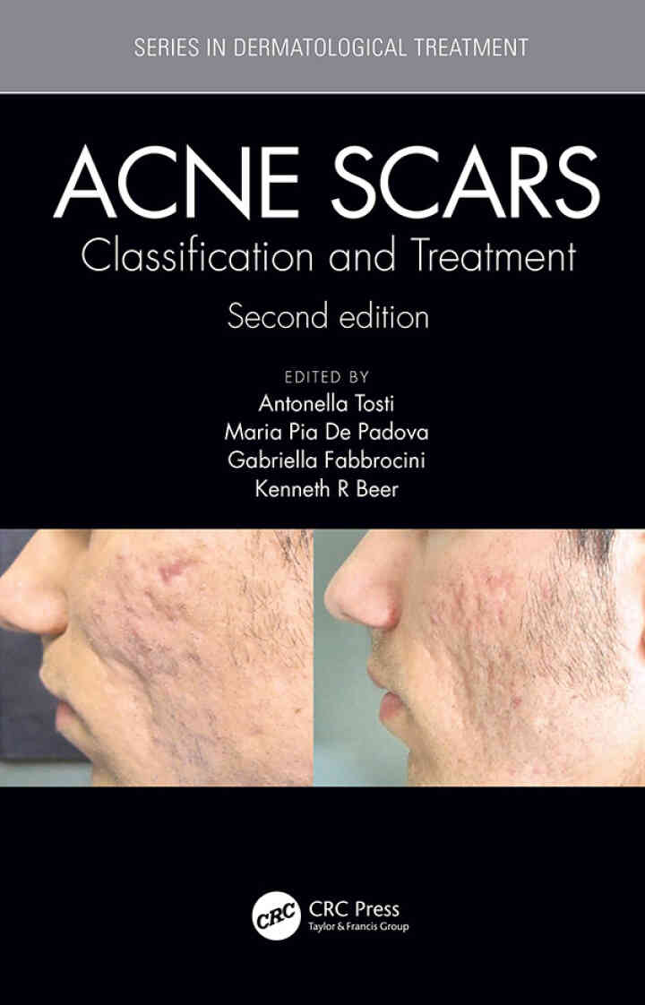 Acne Scars: and Treatment ebook