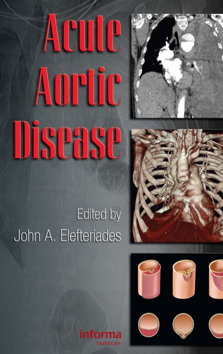 Acute Aortic Disease ebook