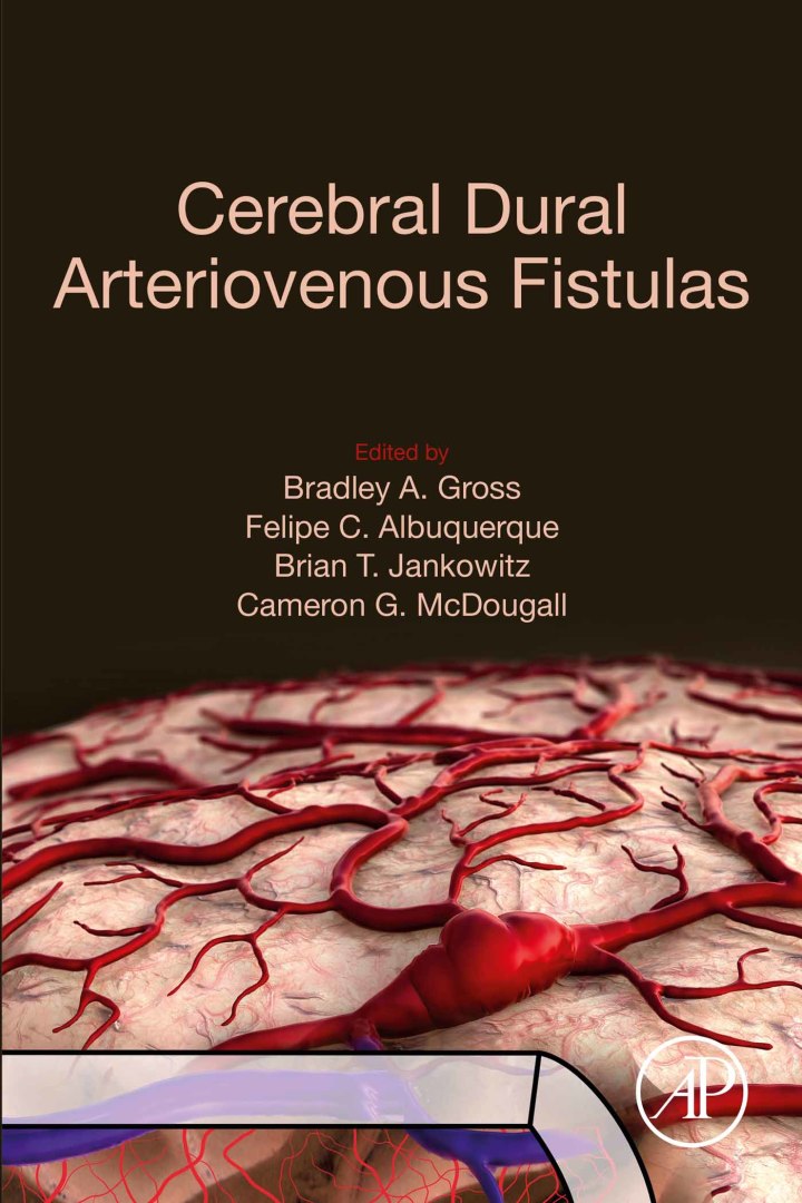 Cerebral Dural Arteriovenous Fistulas ebook