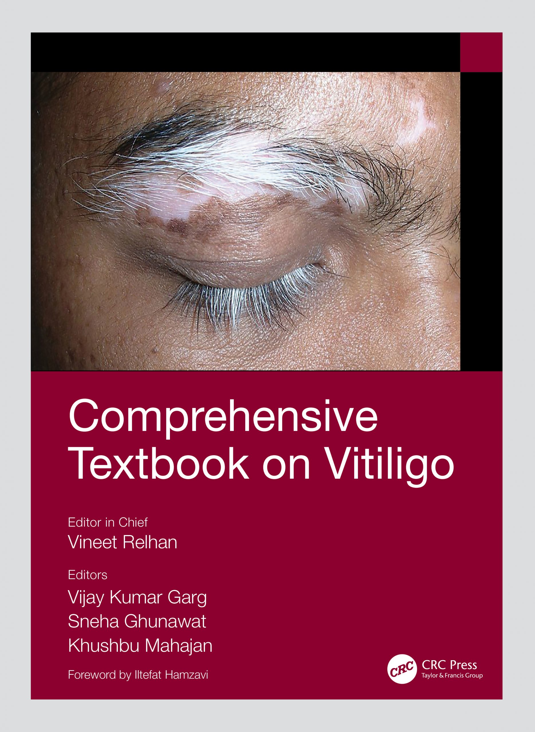 Comprehensive Textbook on Vitiligo ebook