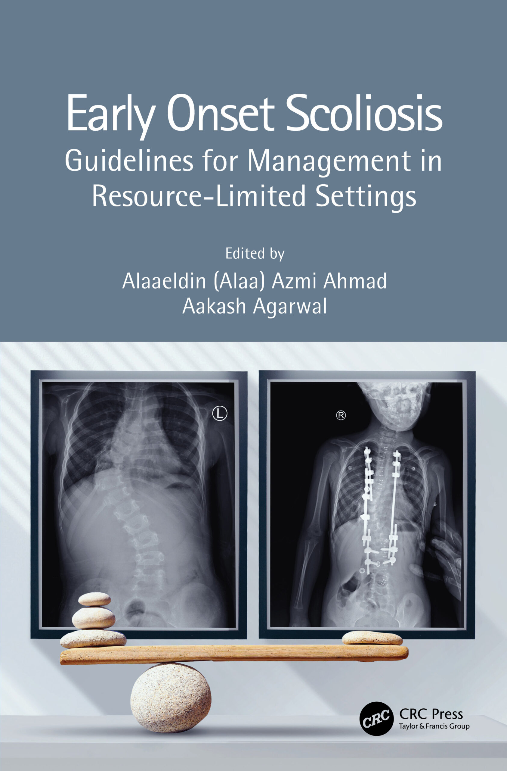 Early Onset Scoliosis: Guidelines for Management in Resource-Limited Settings ebook
