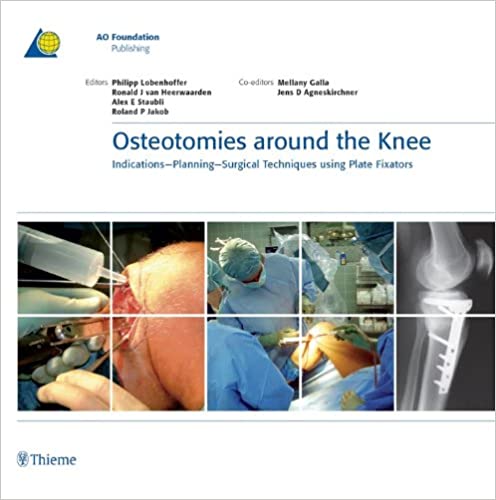 Osteotomies around the Knee: Indications-Planning-Surgical Techniques using Plate Fixators (AO-Publishing) ebook