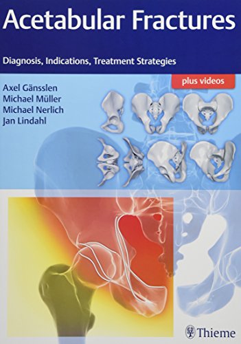 Acetabular Fractures ebook
