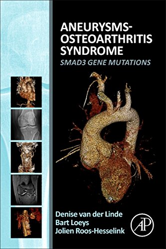 Aneurysms-Osteoarthritis Syndrome ebook