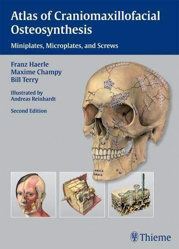 Atlas of Craniomaxillofacial Osteosynthesis: Microplates, Miniplates, and Screws ebook
