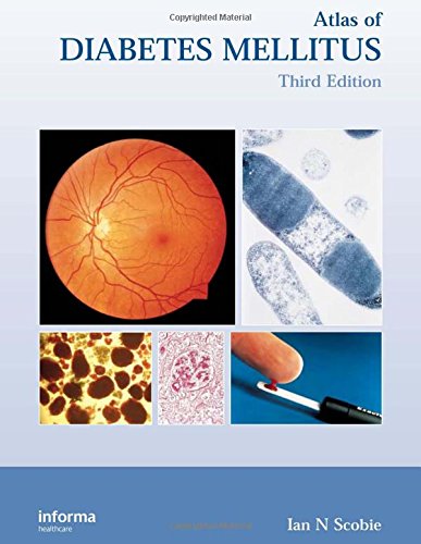Atlas of Diabetes Mellitus ebook