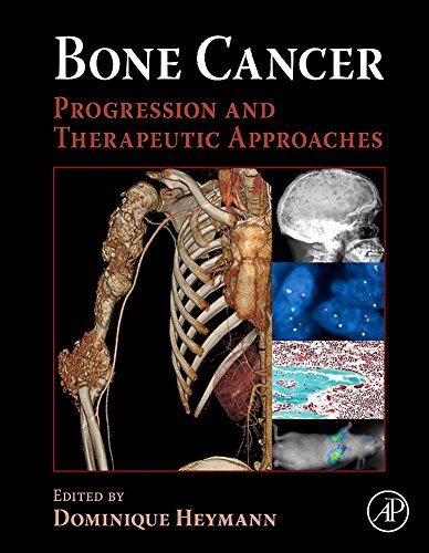 Bone Cancer ebook